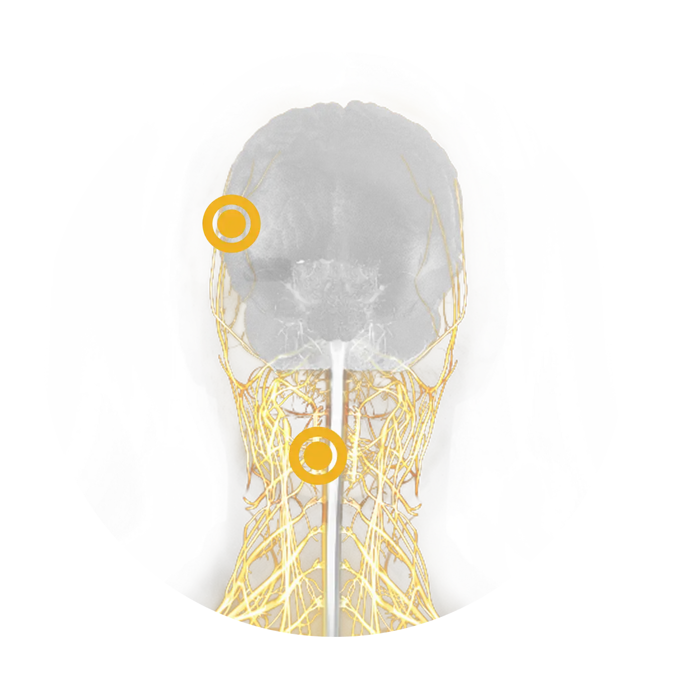 Visual of brain and spinal cord, sites of MSA neurodegeneration, with an indicator signaling irreversible neuronal death
